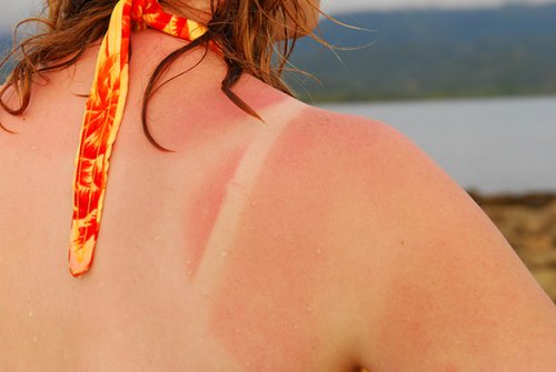 The end of sunburns? Scientists have come up with a drug that could help...